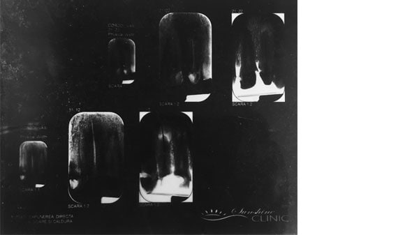 Xrays