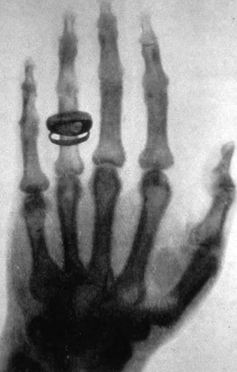 X-ray of Albert von Kölliker's hand
