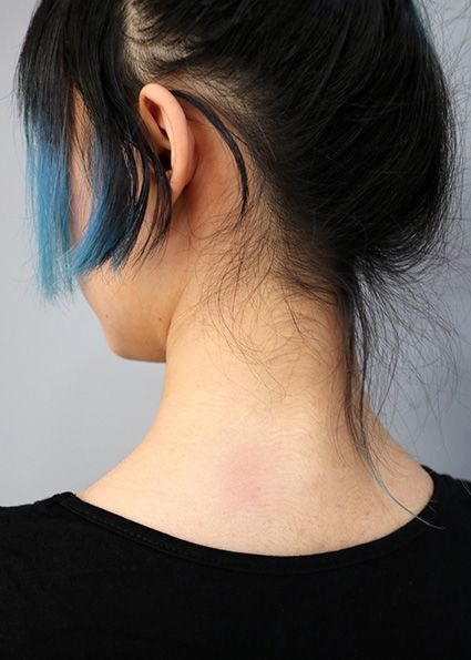 Slight red patch on the back of a person's neck